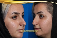 rhinoplasty-17
