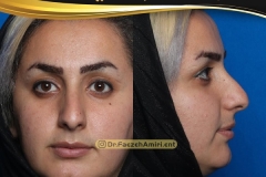 rhinoplasty-18