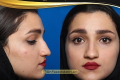 rhinoplasty-19