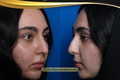 rhinoplasty-20