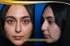 rhinoplasty-21