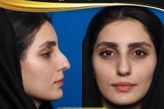 rhinoplasty-22