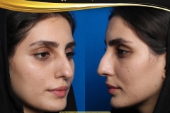 rhinoplasty-23