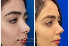 rhinoplasty-24