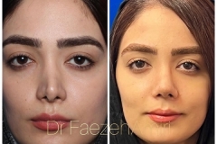 rhinoplasty-25