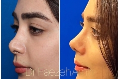 rhinoplasty-26