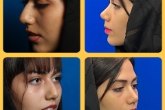 rhinoplasty-27
