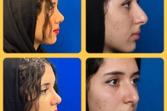 rhinoplasty-28