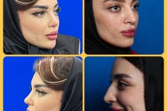 rhinoplasty-29