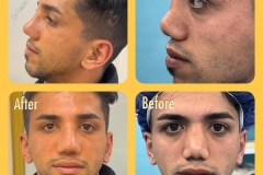 rhinoplasty-34