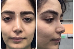 rhinoplasty-38