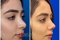 rhinoplasty-39