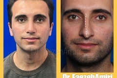 rhinoplasty-41