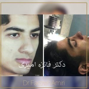 جراحی بینی گوشتی در بابل - دکتر فائزه امیری