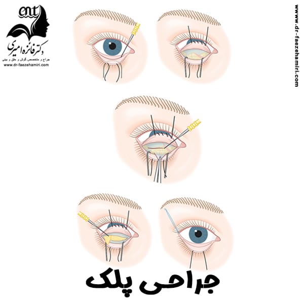 بلفاروپلاستی - دکتر فائزه امیری