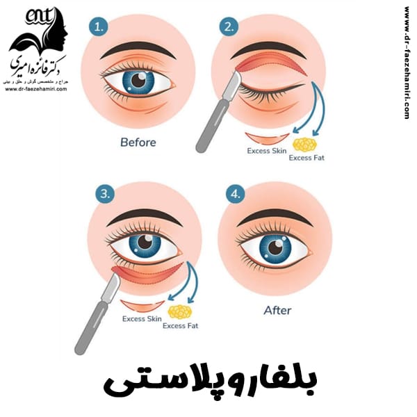 جراحی پلک - دکتر فائزه امیری
