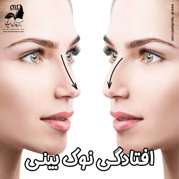 افتادگی نوک بینی بعد از عمل - دکتر فائزه امیری