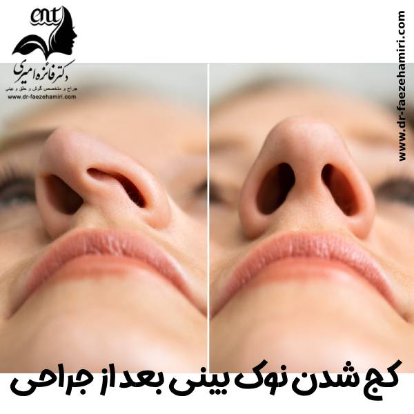 کج شدن نوک بینی بعد از جراحی - دکتر فائزه امیری