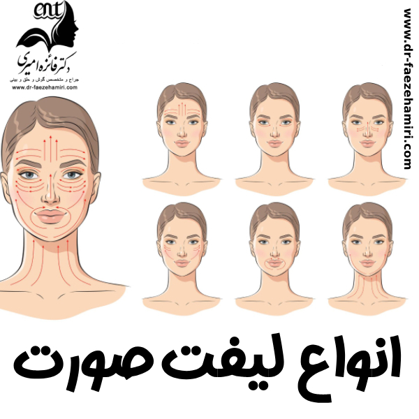 انواع لیفت صورت در بابل با دکتر فائزه امیری